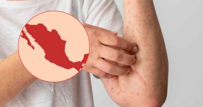 México suma 33 muertes por brote de sarampión; Salud intensifica campaña de vacunación