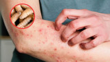 Salud de Tamaulipas confirma segundo caso de gusano barrenador en humano