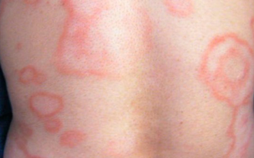 Casos de lepra en 18 estados de México 