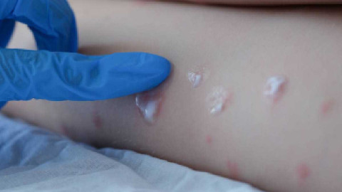 Viruela del mono se puede frenar: OMS