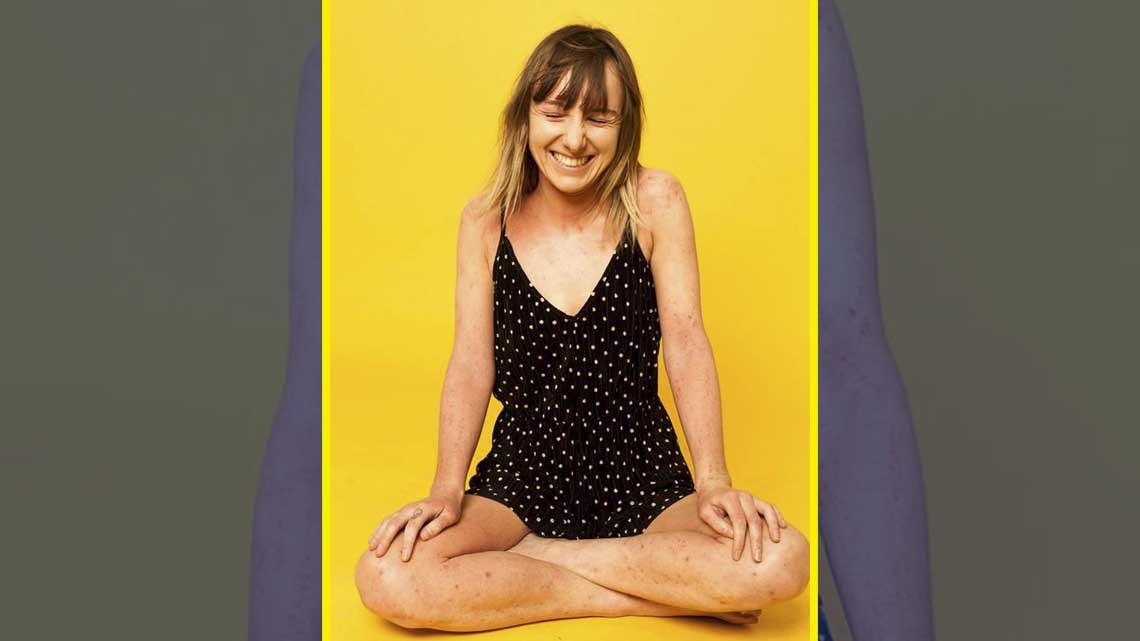 Así celebramos los "defectos" en la piel