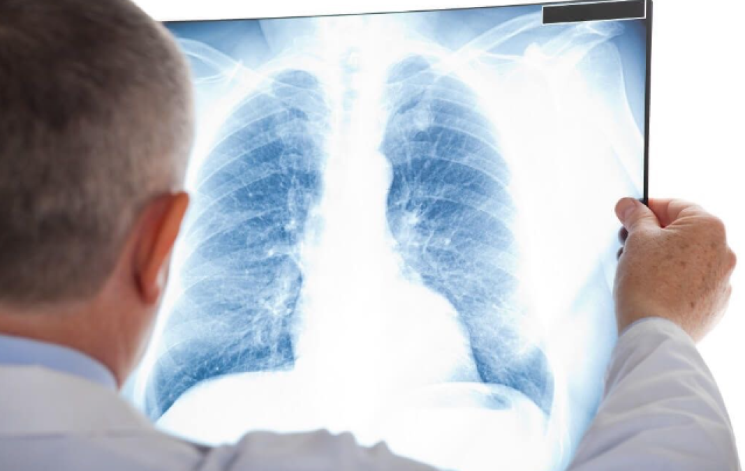 Argentina reporta tercera muerte por neumonía de origen desconocido