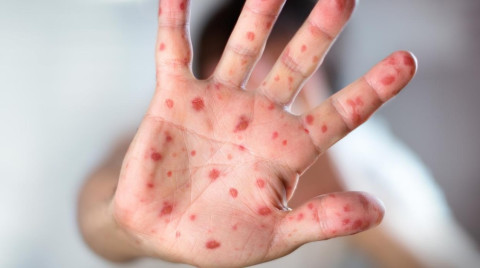 La OMS cambiará el nombre de la viruela del mono