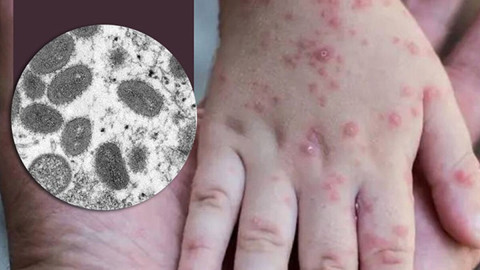 Declara EU emergencia de salud pública por brote de viruela del mono