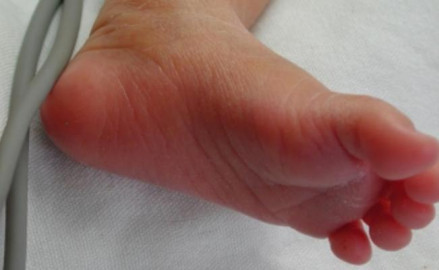 Muere bebé por sobredosis de marihuana