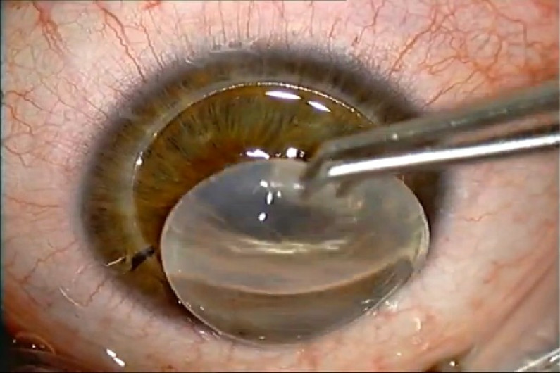 Hospital General listo para trasplante