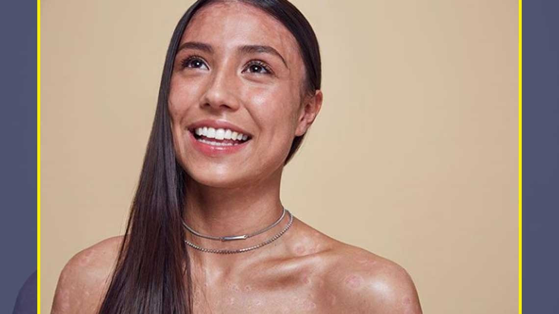 Así celebramos los "defectos" en la piel