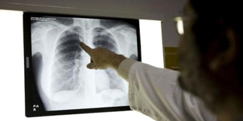 Detectan 119 casos de tuberculosis 