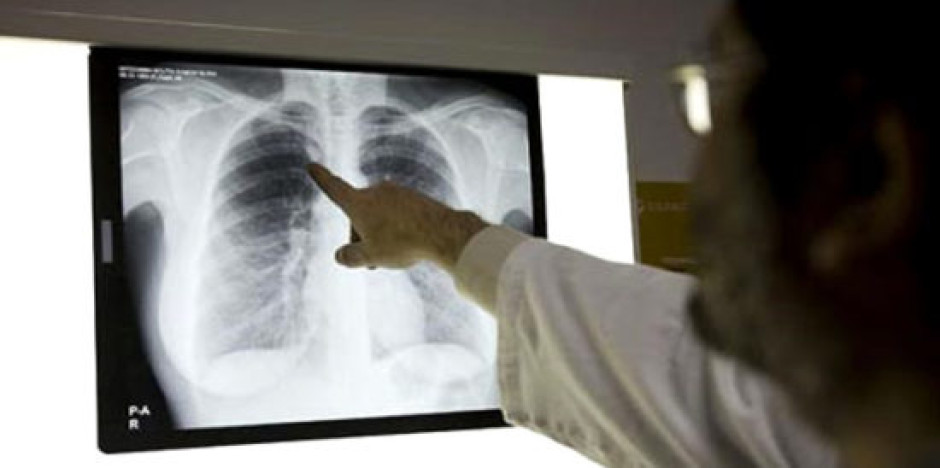 Detectan 119 casos de tuberculosis 