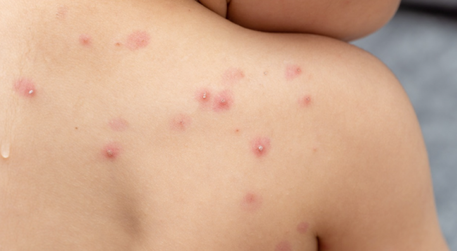 Alerta OPS sobre que América es el epicentro de la viruela del mono