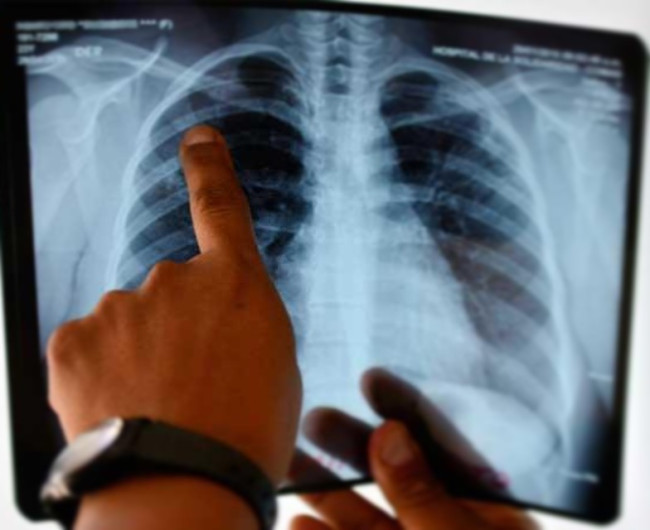 Crecen casos de tuberculosis en invierno