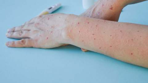 América registra casi un tercio de casos de viruela del mono en el mundo: OPS