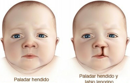 Inicia Club Rotario Programa para beneficiar a niños con paladar hendido 