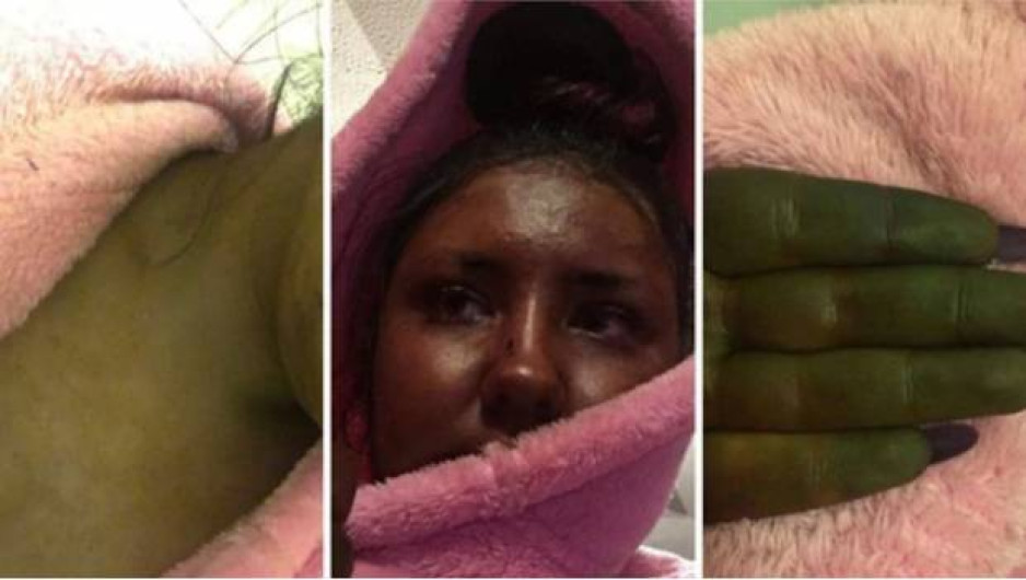 Bronceador le deja la piel verde y la comparan con fiona