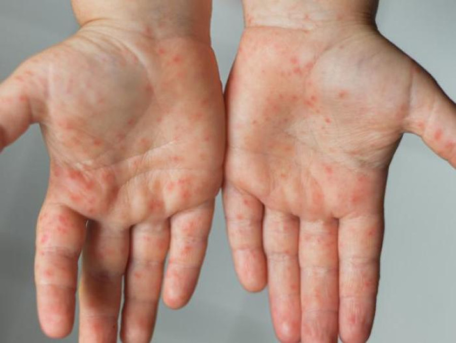 Anuncia EU que emergencia sanitaria por viruela del mono terminará en enero