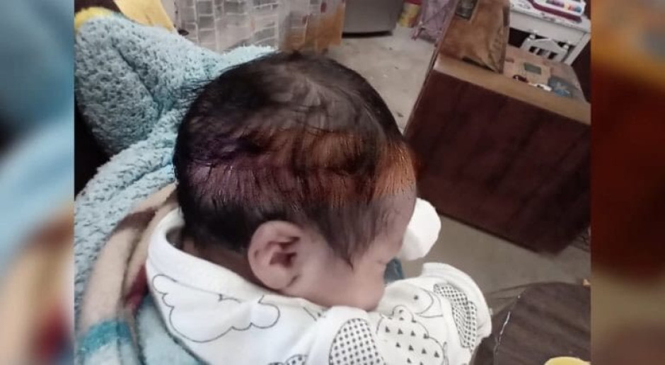 Cortan 15 centímetros de cabeza a bebé durante cesárea en IMSS 