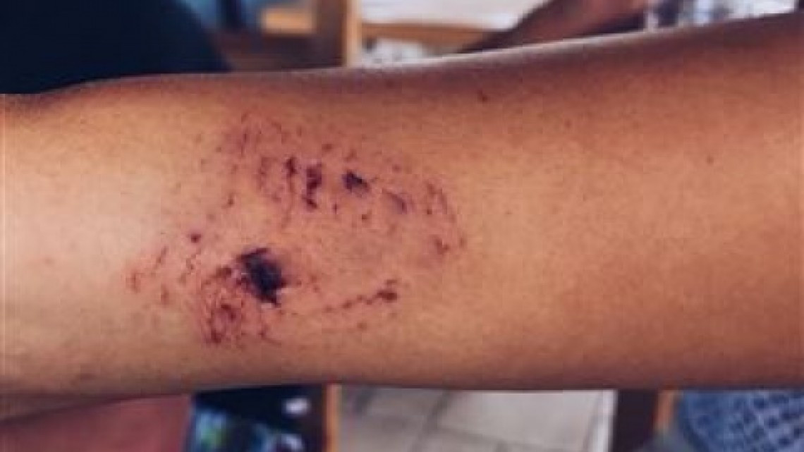 Modelo es atacada por tiburón mientras era fotografiada