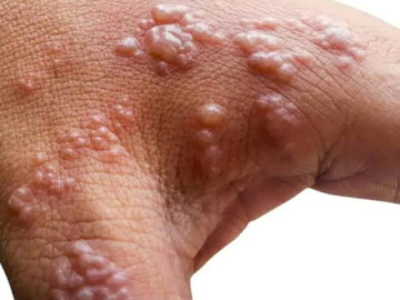 Australia investiga su primer caso probable de viruela del mono